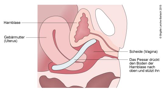 Der Pessar-Ring hebt und fixiert den Blasenboden. Der Pessar-Ring hebt und fixiert den Blasenboden.