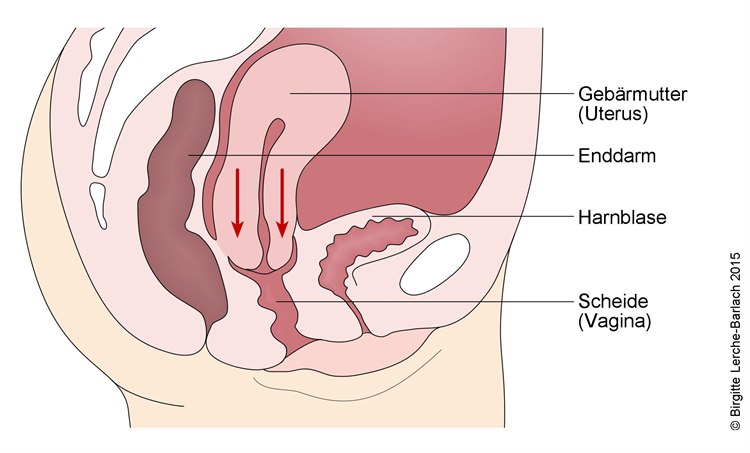 Gebärmuttersenkung Descensus uteri