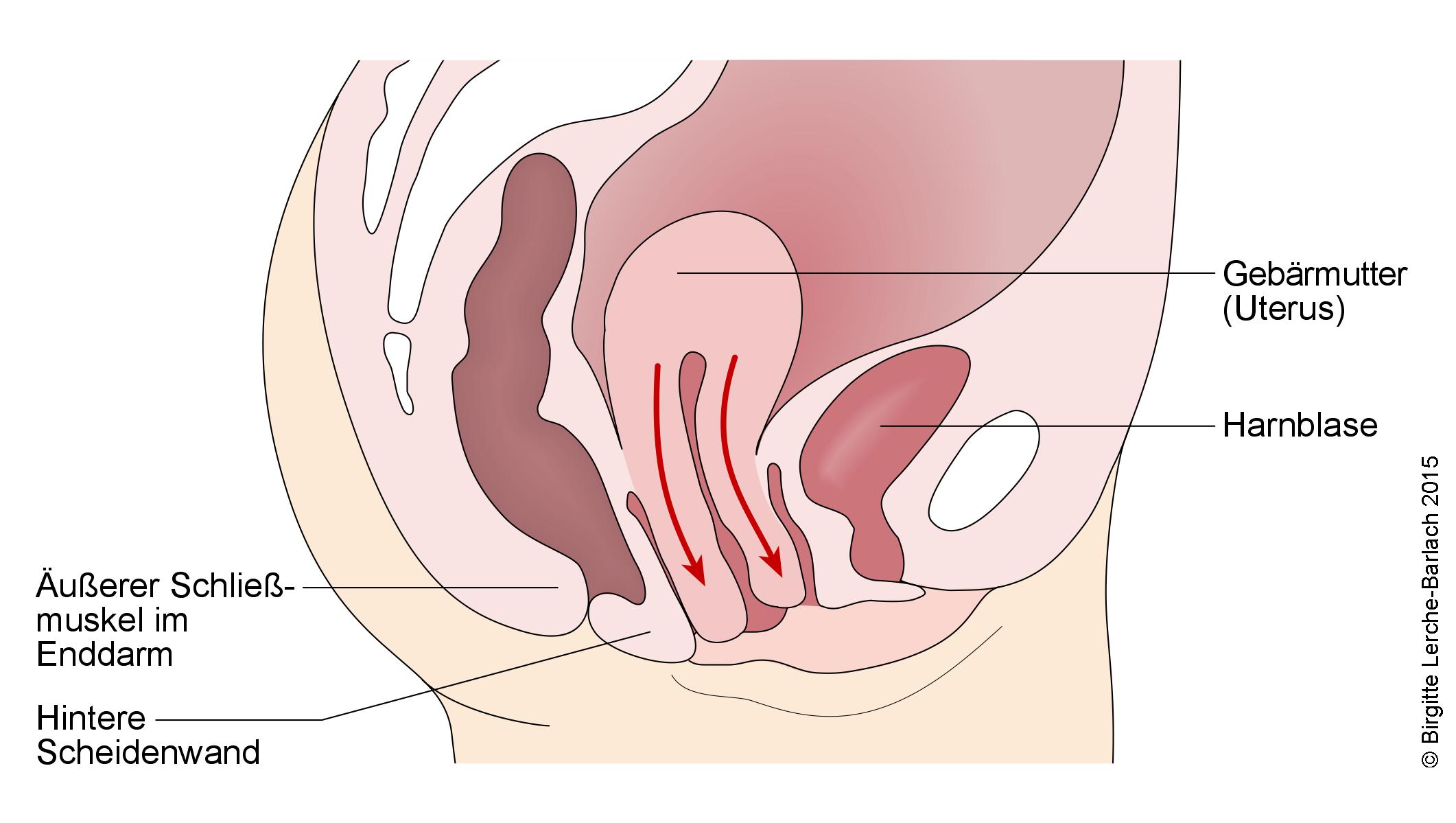 Gebärmuttervorfall Uterusprolaps