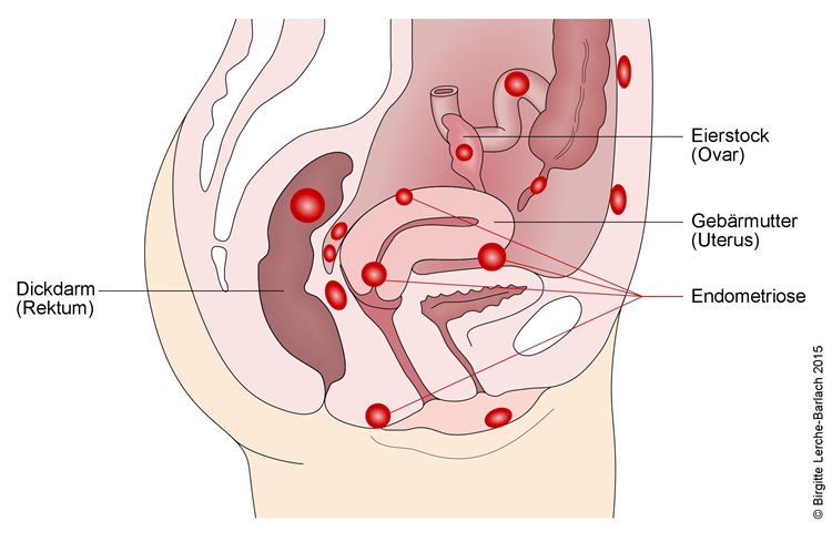 Endometriose, verschiedene Lokalisationen Endometriose, verschiedene Lokalisationen