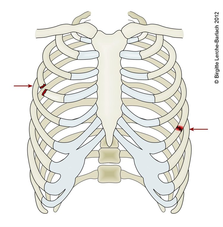 Rippenfraktur.jpg Rippenfraktur.jpg