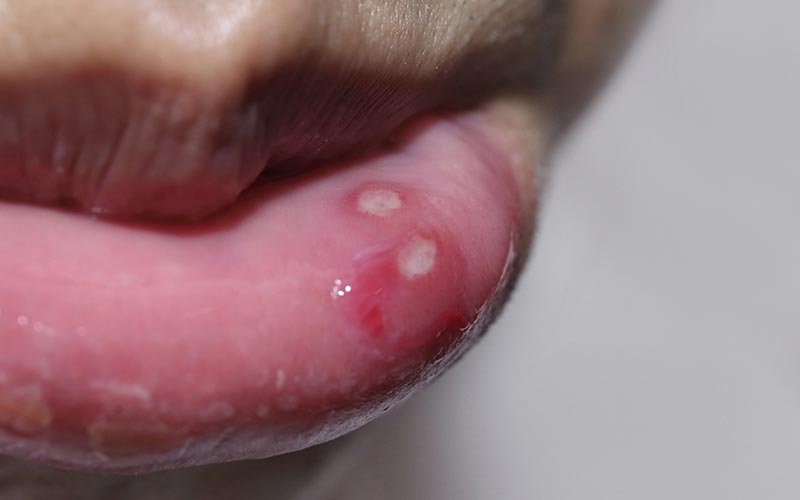 Herpes-Bläschen an den Lippen Mundfäule.jpg