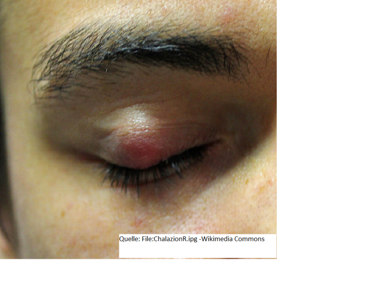 Chalazion (Quelle: Wikimedia Commons) Chalazion.png