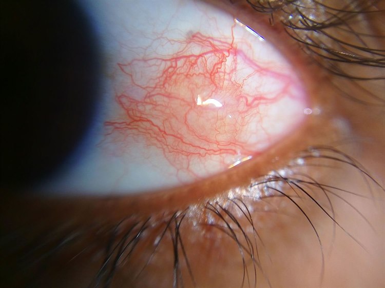 Episkleritis (Quelle: Wikipedia https://en.wikipedia.org/wiki/Episcleritis) Episcleritis.jpg