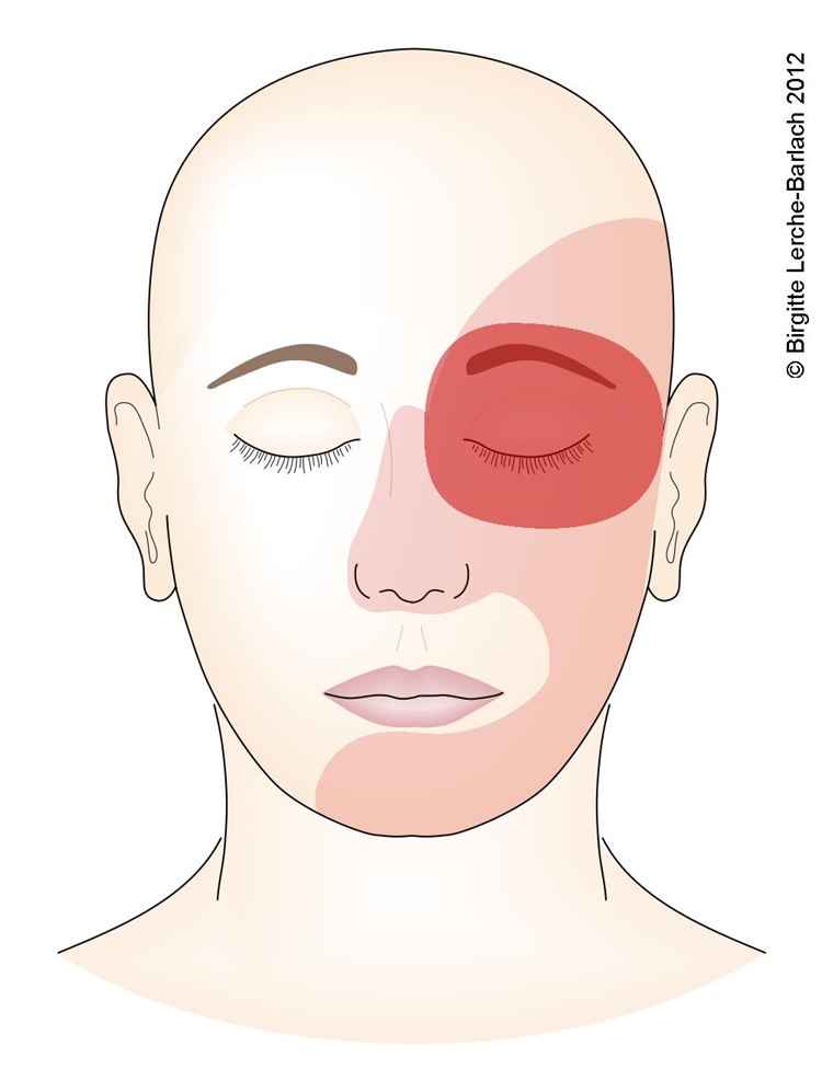Heftige Schmerzattacken, in der Regel hinter einem Auge auftretend Heftige Schmerzattacken, in der Regel hinter einem Auge auftretend
