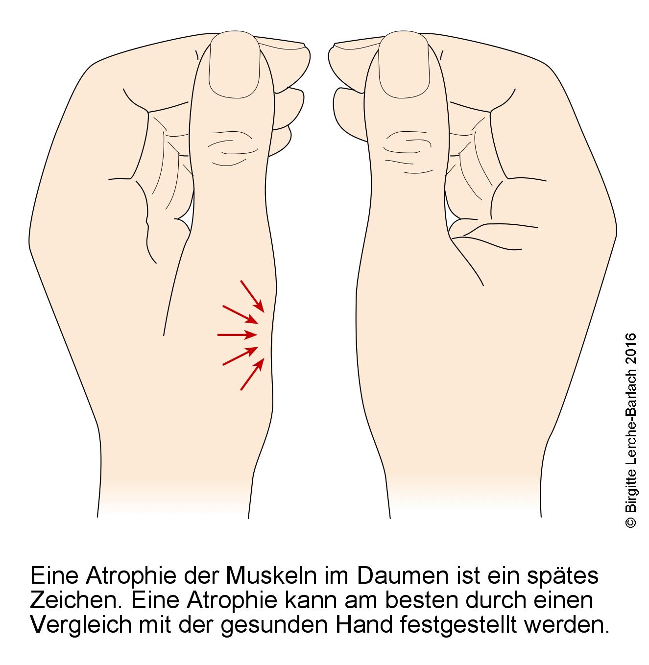 Muskelschwund bei Karpaltunnelsyndrom Karpaltunnelsyndrom, Atrophie.jpg