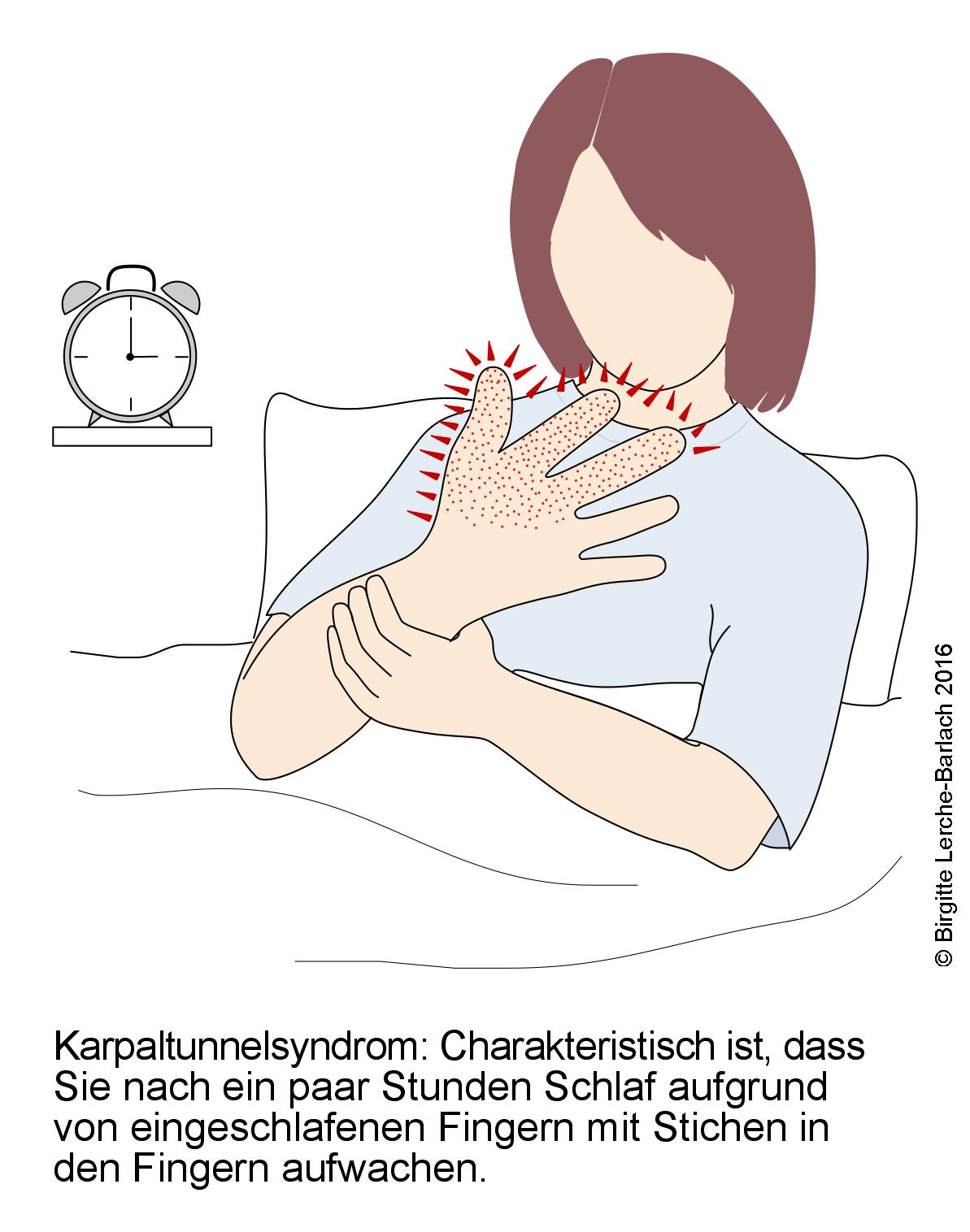 Karpaltunnelsyndrom, Gefühllosigkeit in den Fingern Karpaltunnelsyndrom, Gefuehllosigkeit in den Fingern.jpg