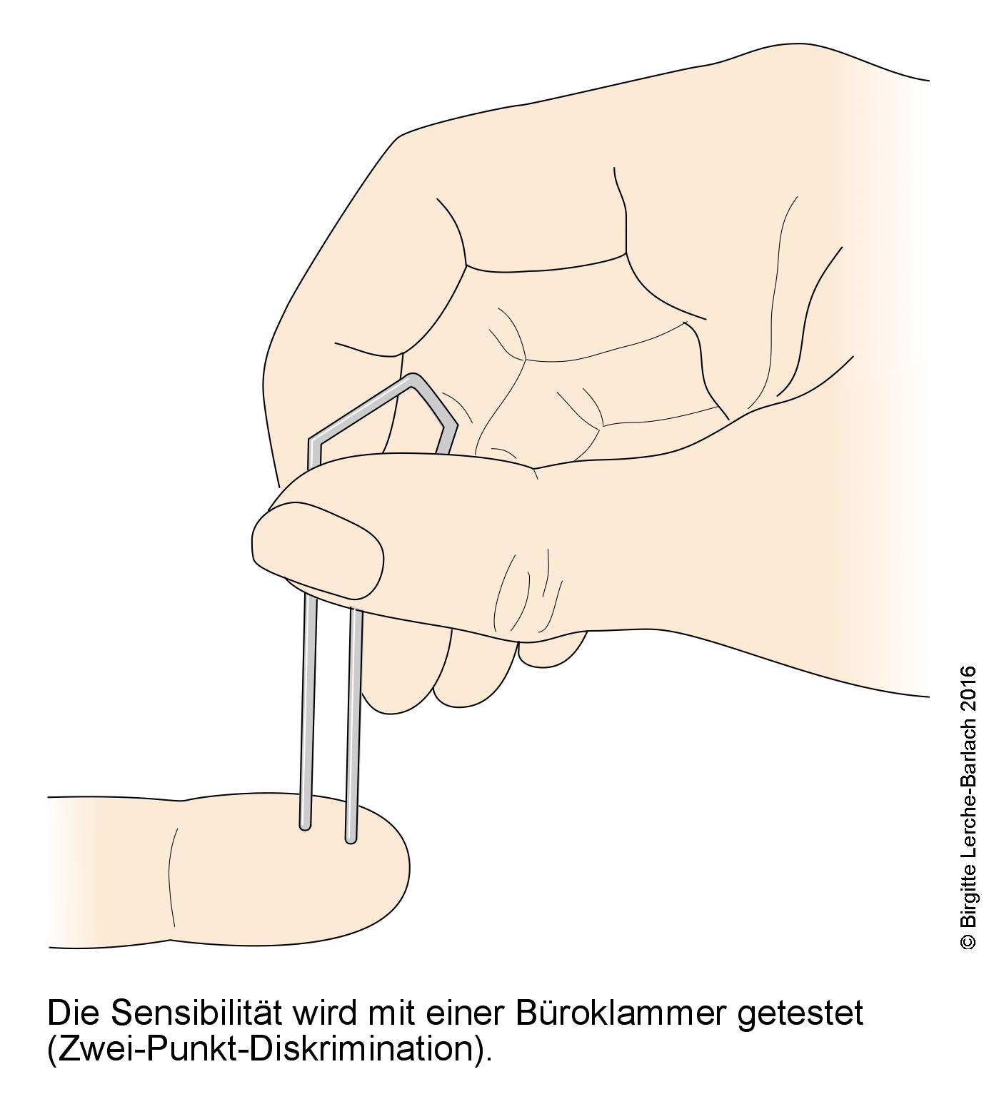 Karpaltunnelsyndrom, Sensibilitätstest.jpg Karpaltunnelsyndrom, Sensibilitätstest.jpg