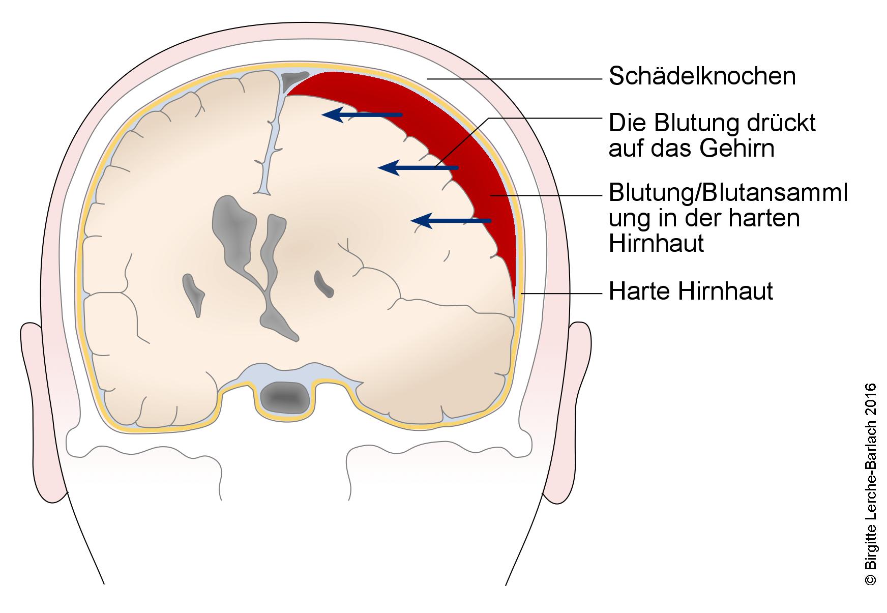 Subdurales Hämatom Subdurales Hämatom