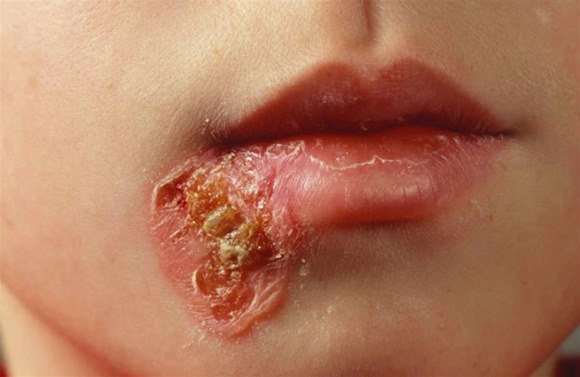 Borkenflechte Impetigo contagiosa