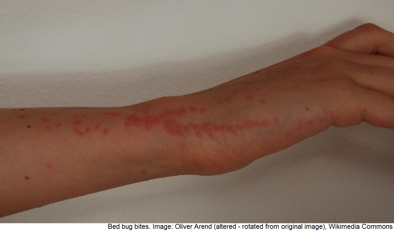 Bettwanzenstiche mit typischer Stichstraße (Quelle: Wikimedia Commons) Bettwanzenstiche_Arm.jpg