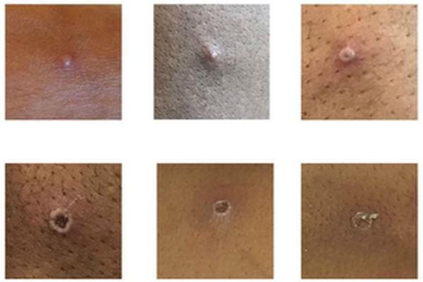Mpox, Läsionen (Quelle: Wikimedia https://commons.wikimedia.org/wiki/File:Photos_of_monkeypox_in_British_patients,_May_2022.jpg) Photos_of_monkeypox_in_British_patients,_May_2022.jpg